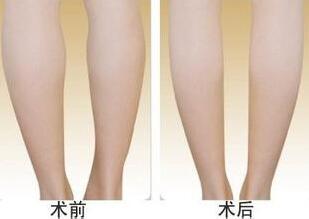 北京瘦腿瘦小腿有效果吗