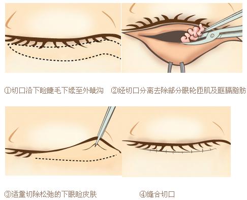 北京韩式祛眼袋有什么优势呢