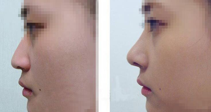 隆鼻手术，为什么术后效果会不同