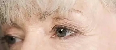 自然老化形成眼角纹