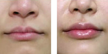 玻尿酸丰唇前后对比图