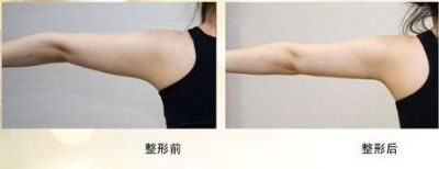 北京艺星做手臂吸脂的费用大概是多少